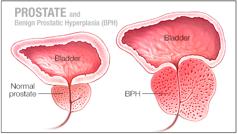 Prostatita sau inflamatia prostatei: cauze, simptome, tratament