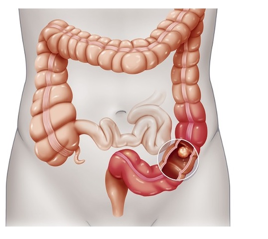 Storosios žarnos vėžys - kas tai?