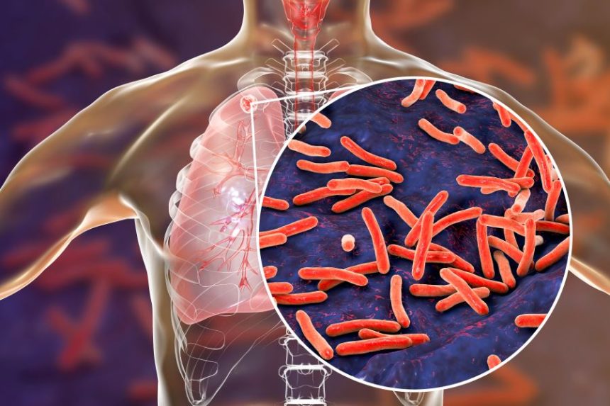 Tuberkuliozė – simptomai ir priežastys (II)